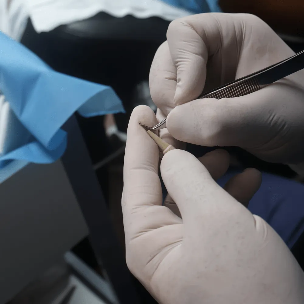 Hair transplant on women